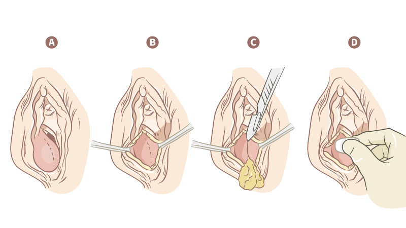 外陰部「腫痛」坐立難安 就醫檢查竟是巴氏腺囊腫！